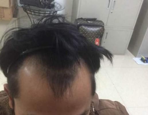 25岁男子雄秃4年,呈现严重m型发际线,植发至少需要3万多