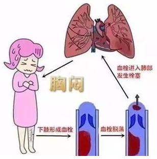 6,肺栓塞是一种很严重的疾病吗?
