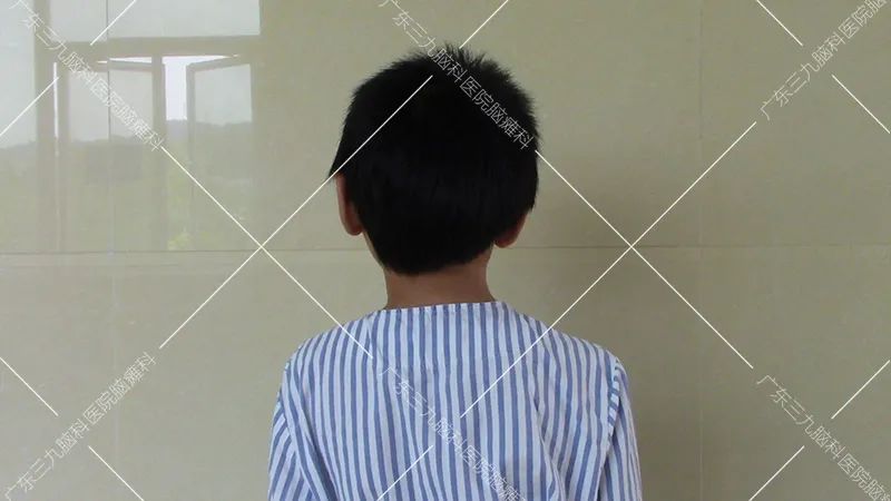 11岁男童"歪脖子",手术让他"正面人生"