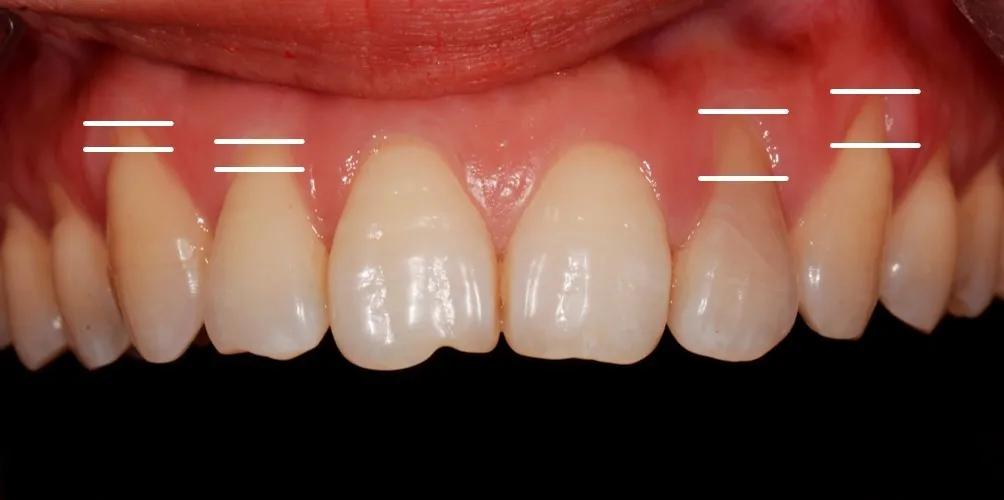 臨床檢查可見左上側切牙(#22)和尖牙(#23)牙齦退縮超過2mm,右上側切牙