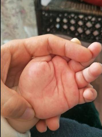 怎样分辨孩子是不是积食医生看5个信号中了2个及时上医院