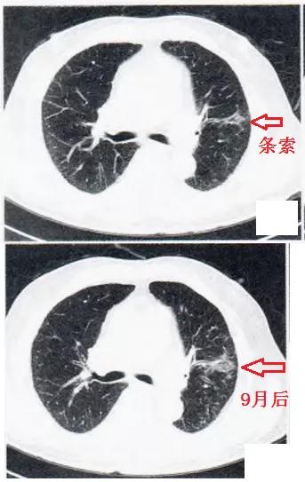这份「肺纤维化 肺癌」读片秘籍,请收好