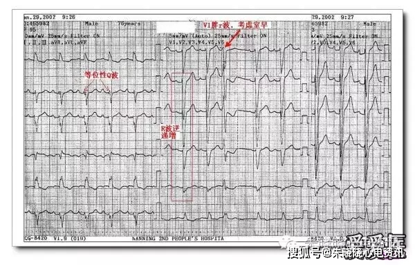rv3,rv4即为等位性q波改变,提示陈旧性前壁心肌梗死