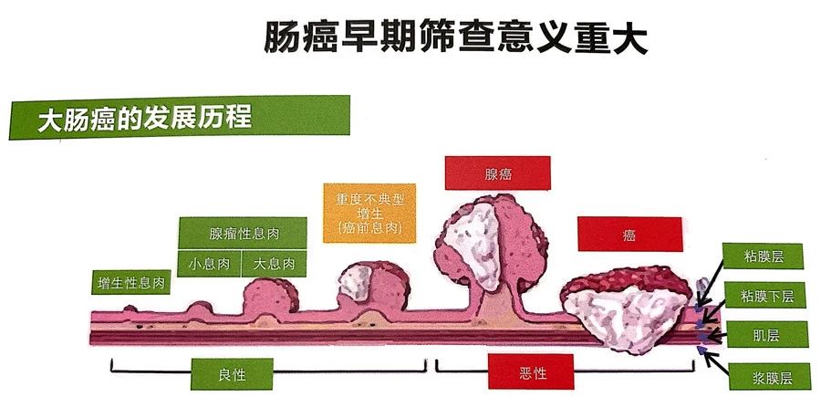 【湖南大康医疗】无痛无创的肠癌早期检测利器,很多人都不知道