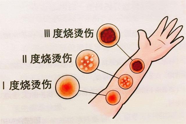 兒童和孩子生理學的特點,導致他們被燒或燙傷之後的 致殘率和死亡率