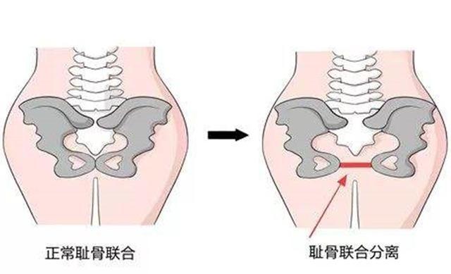 3)胎儿入盆临近预产期时,胎儿头的位置逐渐向下移,会压迫到孕妇的骨盆