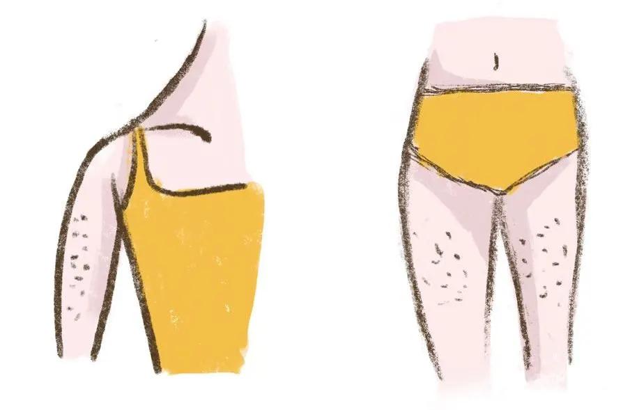 夏天到了,恼人的「鸡皮肤」该如何改善_图片