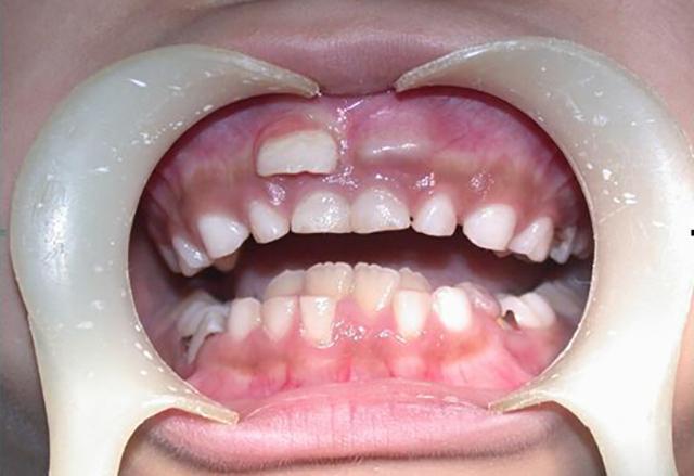 孩子出现双排牙需不需要将乳牙拔掉医生提醒要视情况而定