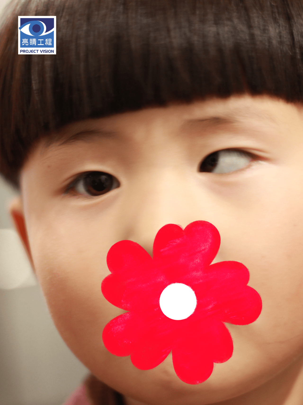99公益 | 为斜视儿童争取,一个光明的未来