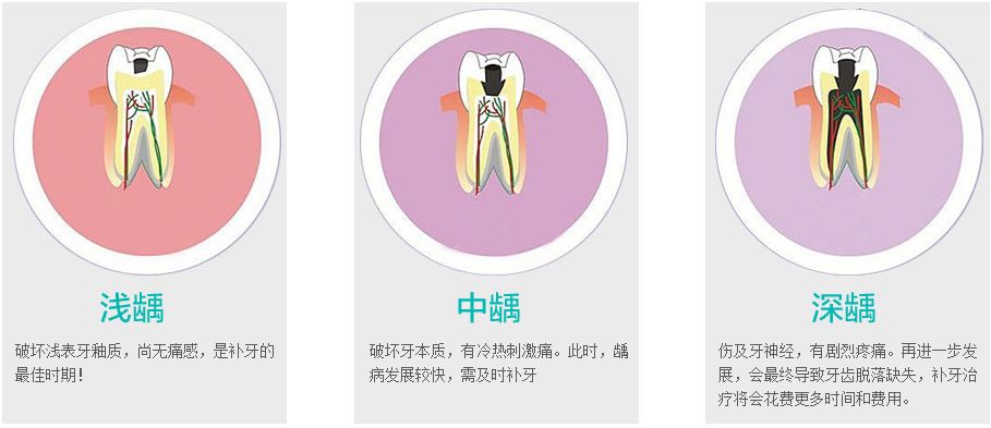 浅龋、中龋、深龋如何治疗?-搜狐大视野-搜狐新闻