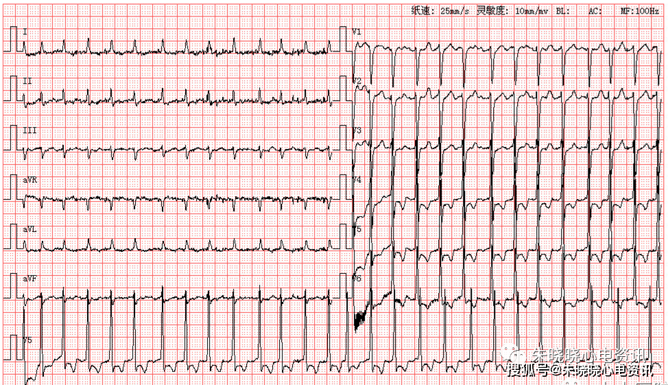 编辑欢迎各位老师文章底部留言次日发送心电读图参考解析