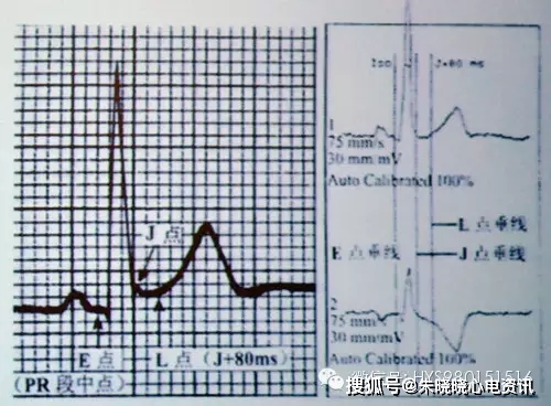 臨床必備:2小時學看心肌缺血心電圖