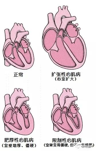 扩张性心肌炎图片