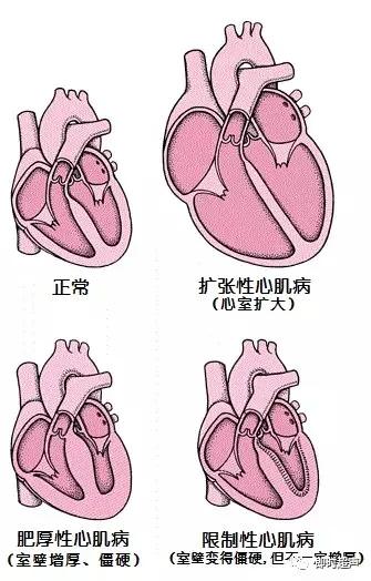 扩张型心肌病以心室扩大心肌收缩功能减退为特点