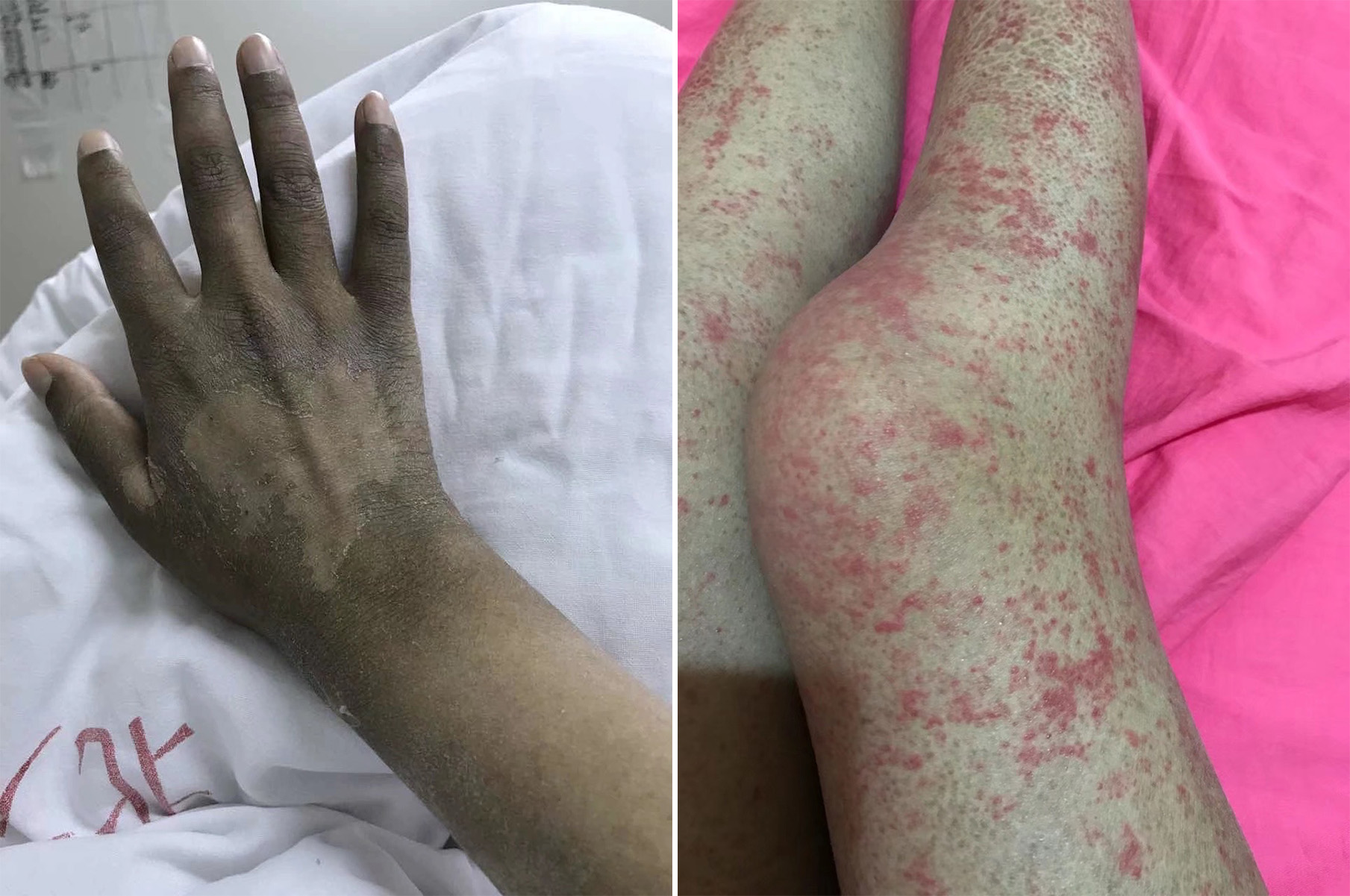 08-24 18:14 "我今年29岁了,15岁上初二那年查出患上再生障碍性贫血