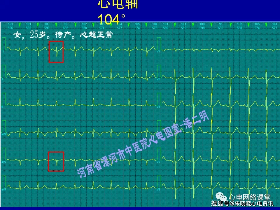 心電軸偏移在心電圖和向量圖上的對比分析