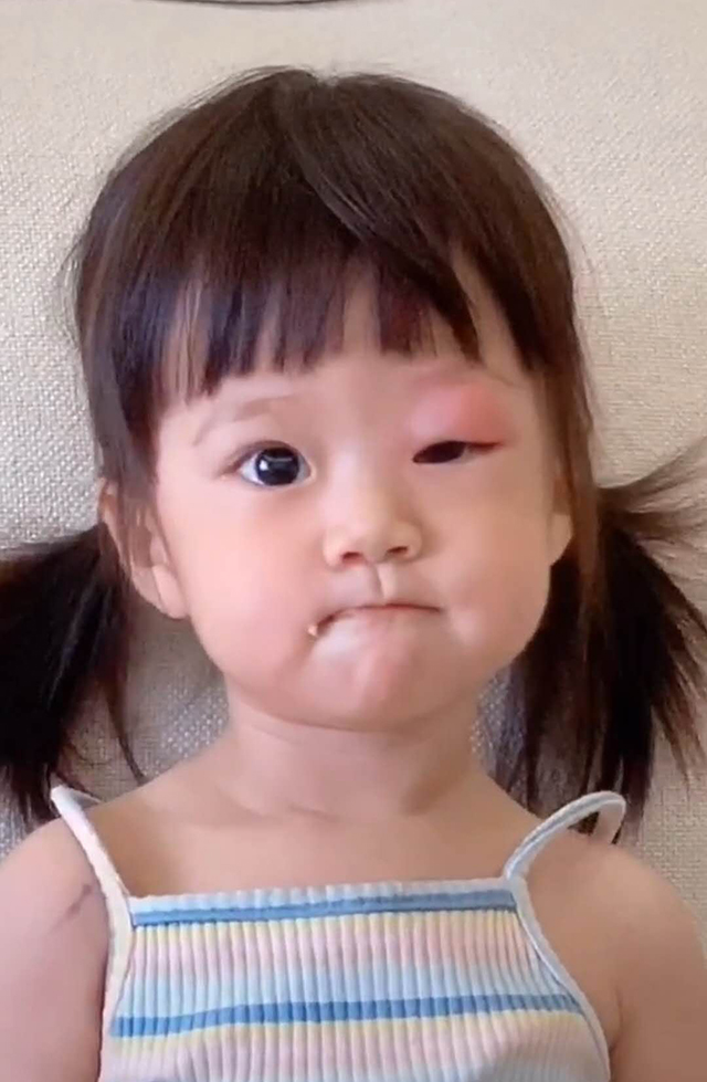 大眼萌娃被蚊子叮了眼皮,"大小眼"模样太可爱,妈妈想笑又心疼