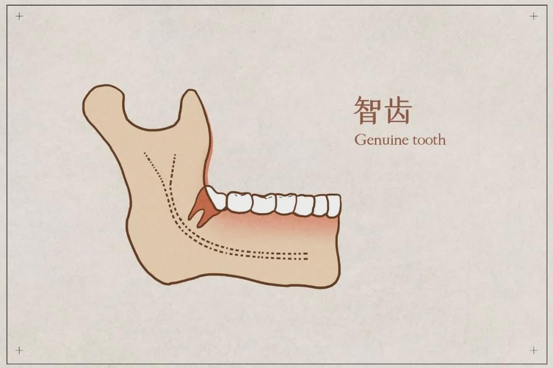 智齿长成这样还不拔,留着发炎吗?