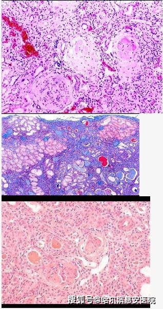 除外非腎源性疾病所致者,如代謝性酸中毒嚴重,血漿hco3- 15～18mmol/l