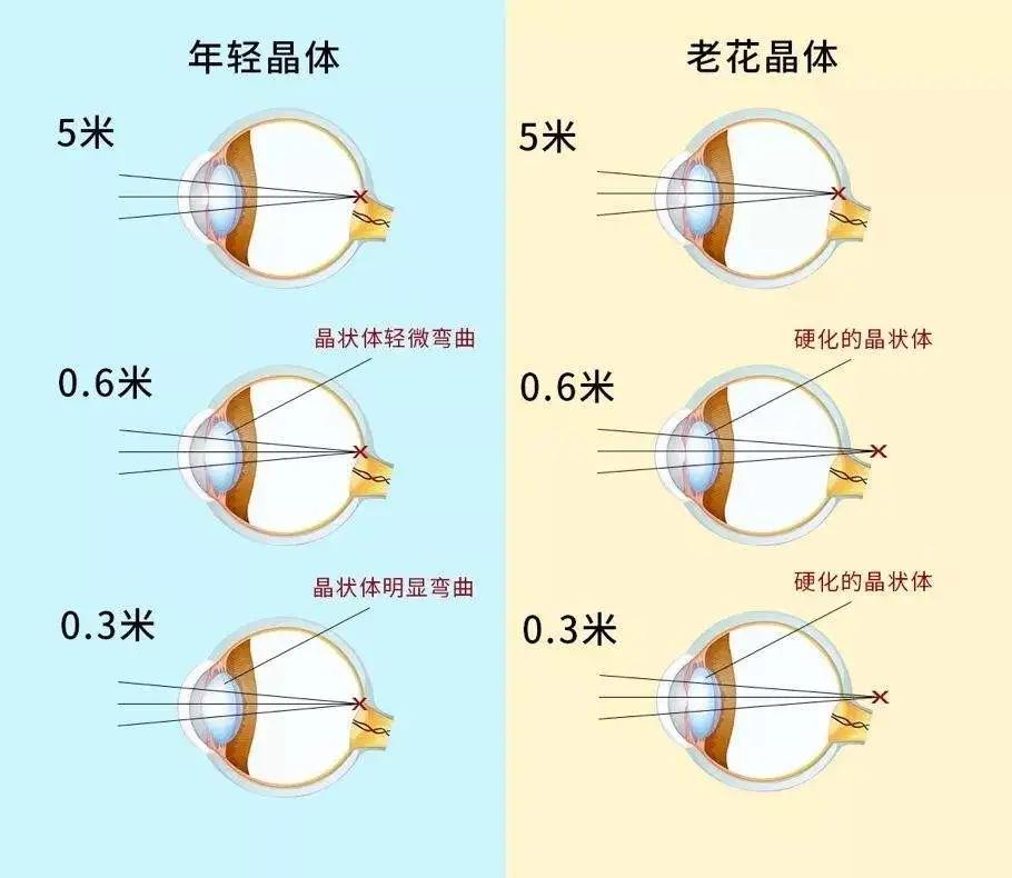 科普时间老花眼远视眼