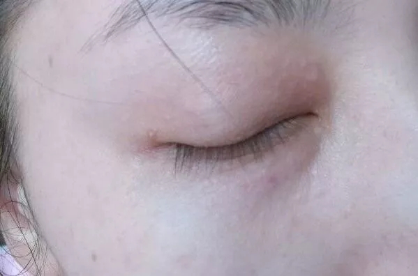 眼睛周围长满汗管瘤,长了十多年现在才慢慢消下去