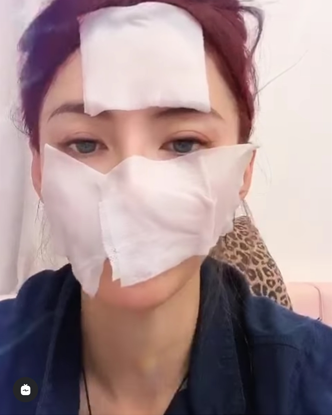 阿娇撞伤头缝上百针后,张柏芝也晒满脸纱布照,网友忙问受伤了?