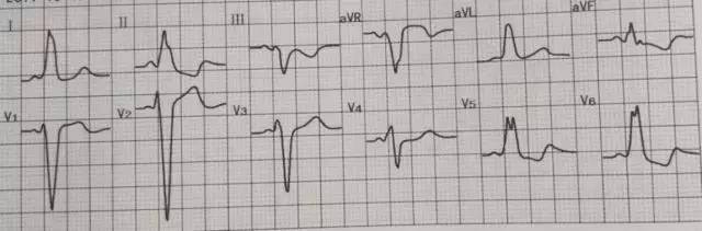 st 段壓低只想到心梗?這 11 種鑑別診斷也應知道_心電圖