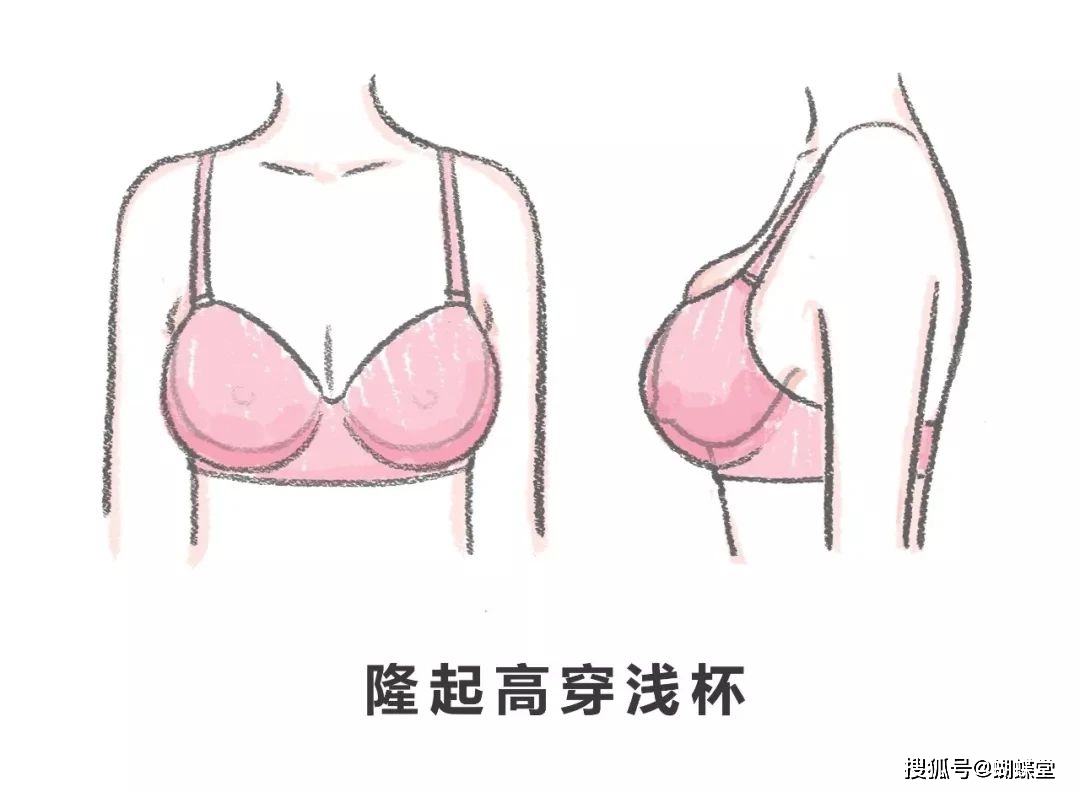 二是钢圈合适但杯型过浅导致的压胸,这种情况在纺锤胸身上尤为常见.