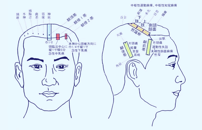 语言一区二区头针图解图片