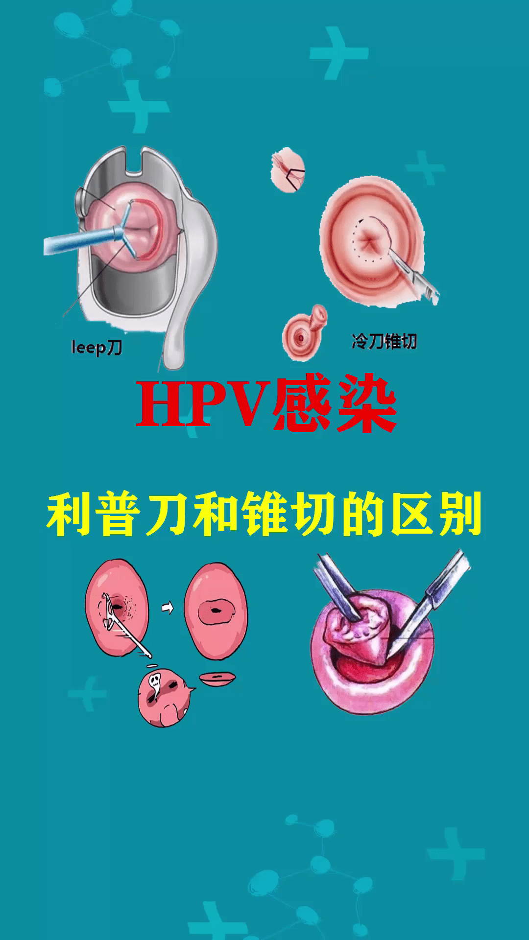 hpv感染,利普刀和锥切的区别