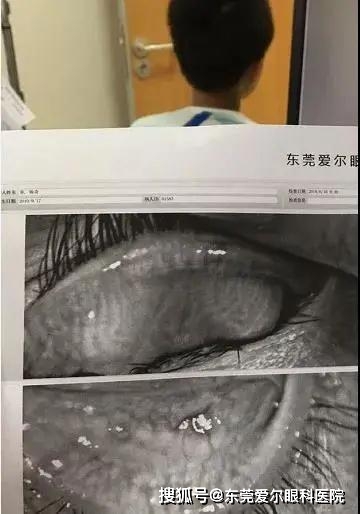 不是危言聳聽你的瞼板腺可能正在消失