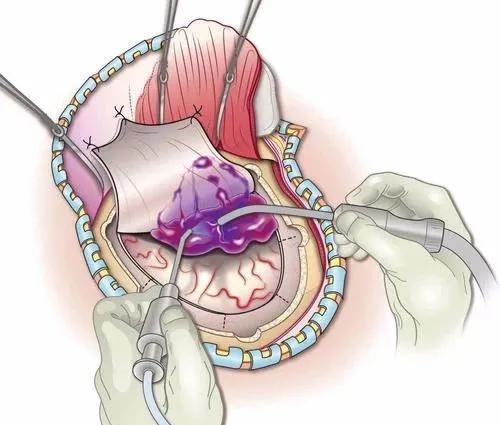 慢性硬膜下血肿治疗分为:手术治疗及保守治疗,其中手术治疗又分为