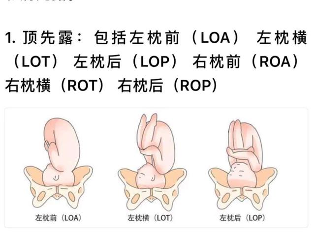 胎位旋转图片