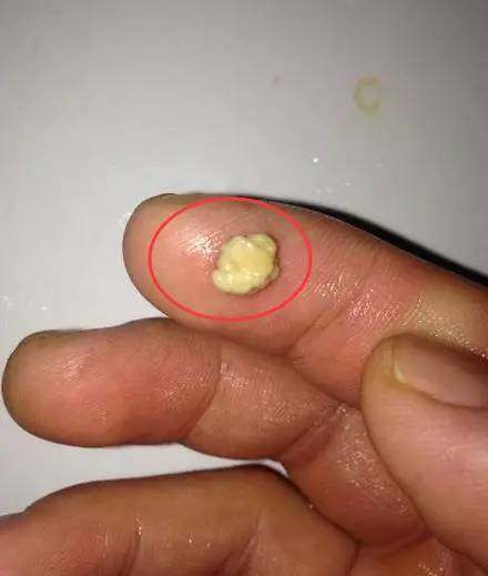 扁桃体结石与牙结石有什么不同?_手机搜狐网