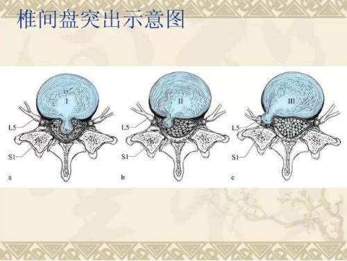 洛阳椎间盘突出邱悬壶图片