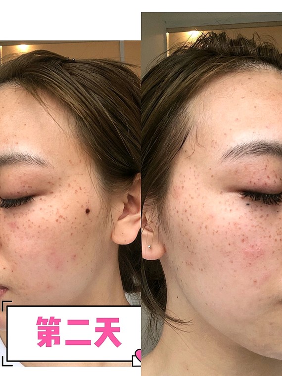 【答疑专场】关于皮秒祛斑的常见问题