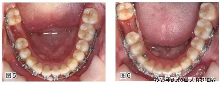 46磨牙拔牙間隙剩餘2 mm,,44,45及36可見牙合面使用了粘接式牙合墊