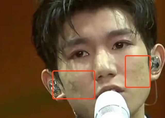 年纪轻轻满脸痘坑,压力太大,好心疼弟弟