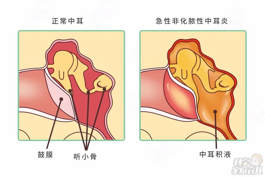 非化膿性中耳炎導致的聽力下降是傳導性的,大多情況下不會讓寶寶失聰.