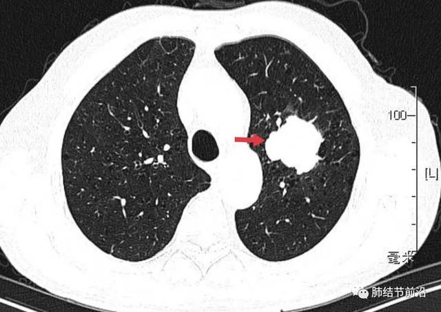 肺結節讀片(13):生長極快的小細胞肺癌結節