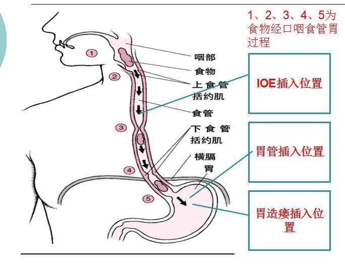 胃管插管的操作方法