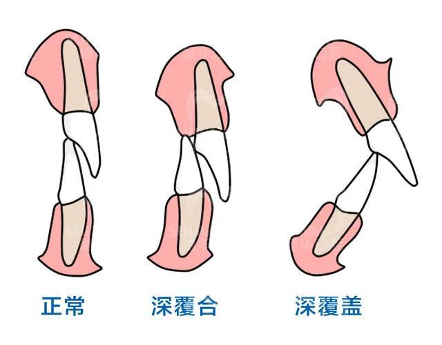 牙齿深覆合,笑起来露出牙龈.破坏美观!