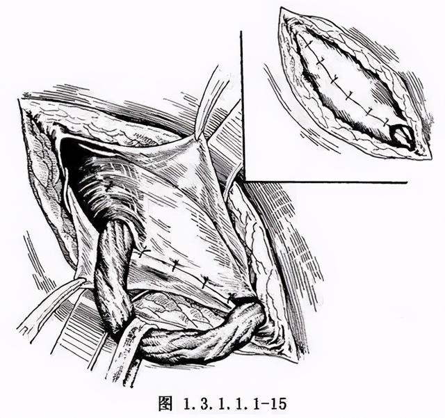 「巴德補片」無張力疝修補術與腹腔鏡微創手術的區別_手機搜狐網