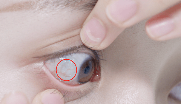 揉眼睛会导致散光