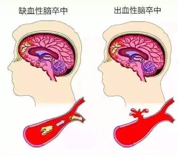 关于脑卒中你要知道.——神经外科