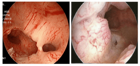 小身材,"大本事"——史托斯宫腔镜下评估子宫内膜癌前病变
