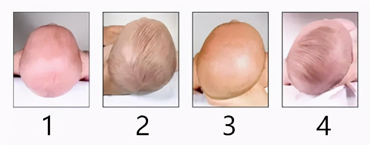 长时间下来,宝宝头部的后部(后脑勺)或侧面持续受压,就容易出现扁平的