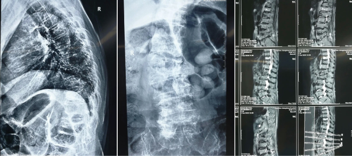 治疗|杭州城东医院案例丨90岁高龄椎体压缩性骨折新技术—?经皮穿刺椎体后凸成形术