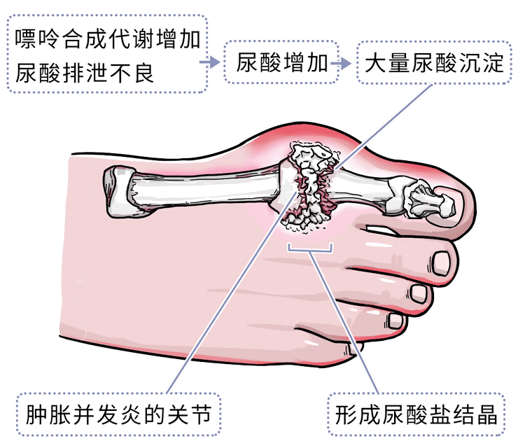 性關節炎很多人第一時間會想到痛風提到高尿酸高尿酸血癥有什麼症狀?