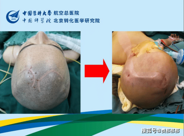 肖庆常规手术艺术化之脑室腹腔分流术头部切口改进